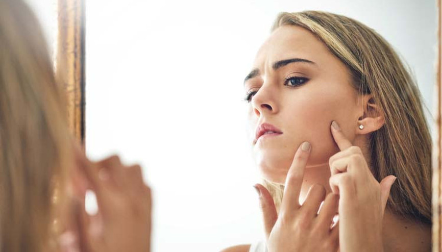Akne ve sivilcelere karşı nelere dikkat edilmeli