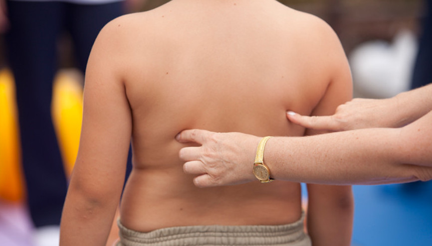 Çocuklarda obezite probleminden dolayı duruş bozukluğu da görülüyor Çocuklarda obezite probleminden dolayı duruş bozukluğu da görülüyor