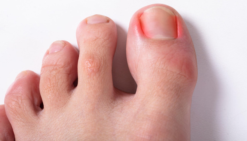 Sıkça karşılaşılan tırnak rahatsızlıkları ve çözümleri