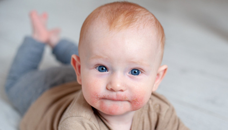 Çocuklarda atopik dermatit neden olur Çocuklarda atopik dermatit neden olur