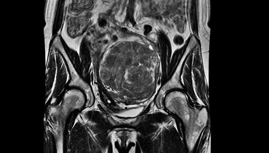 Miyom tedavisinde rahimi korumak için en etkin yöntem hangisi Miyom tedavisinde rahimi korumak için en etkin yöntem hangisi