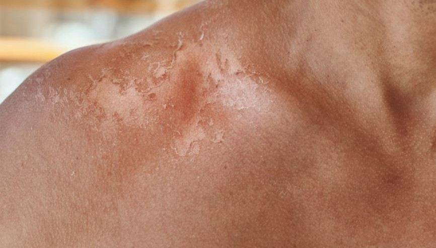 Cilt Soyulması Kalıcı Lekeye Sebep Olabilir