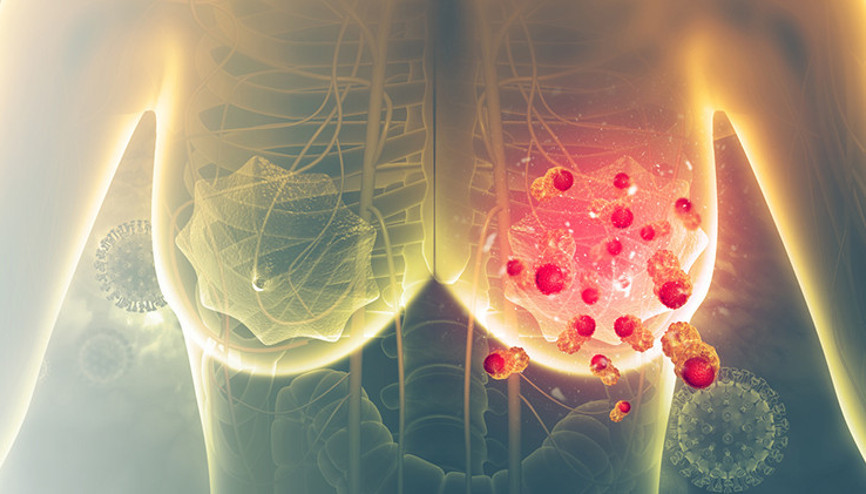 Meme Kanserinde Erken Tanı Neden Önemli