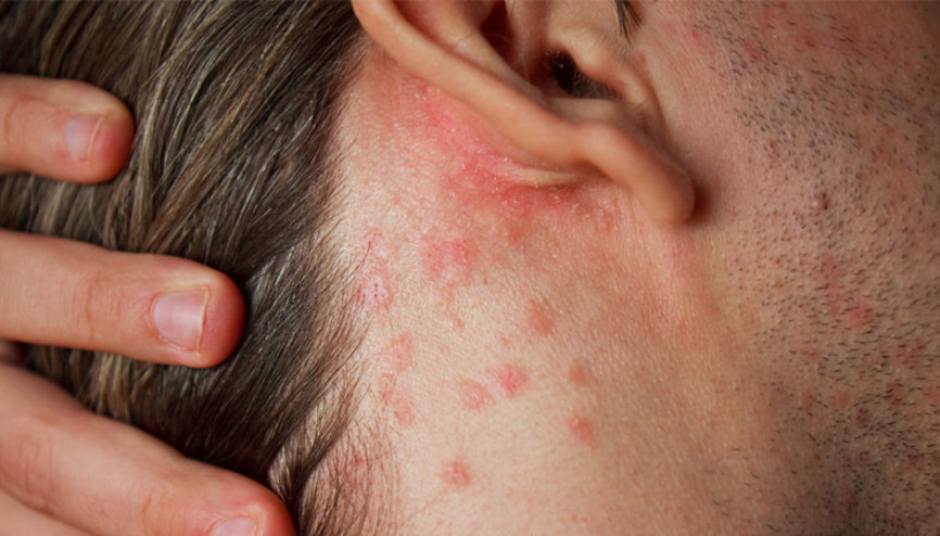 Temasla bulaşıyor, deri altında tüneller açarak yaşıyor