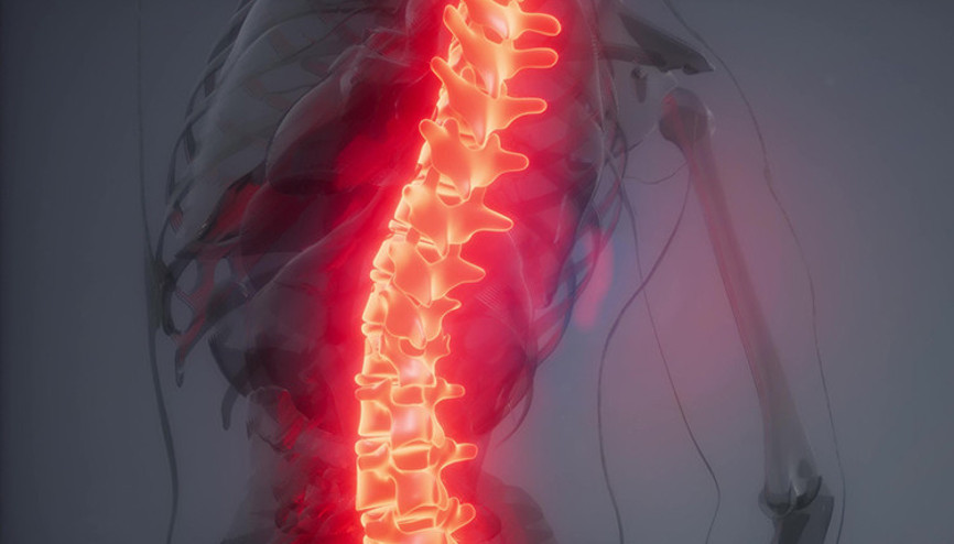 Skolyoz tedavisi nasıl olmalıdır