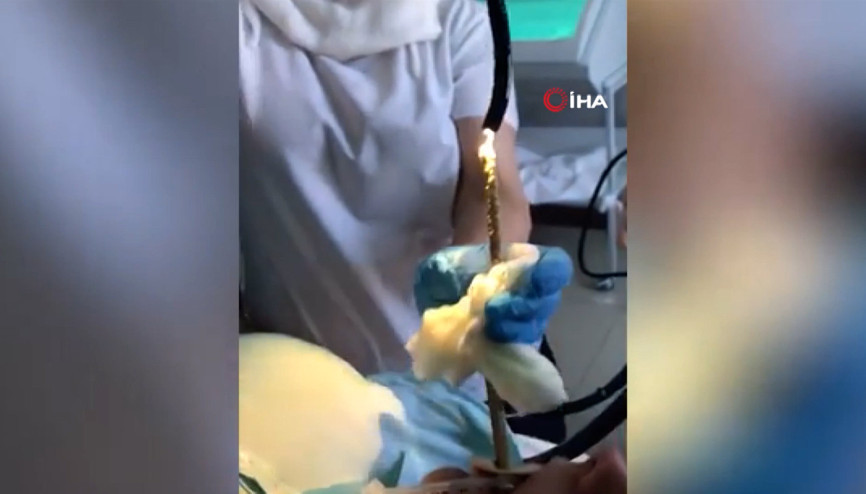 Rusyada uyuyan kadının ağzından giren yılan ameliyatla çıkarıldı Rusyada uyuyan kadının ağzından giren yılan ameliyatla çıkarıldı