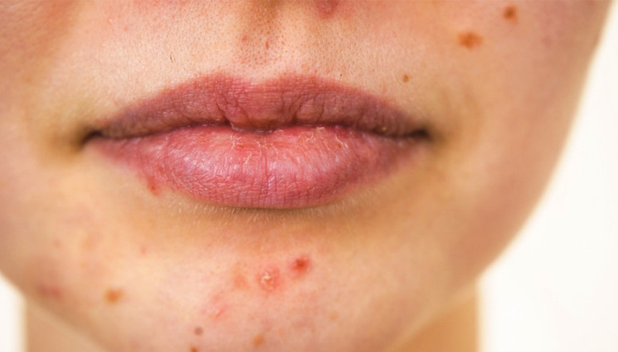 Cilt lekeleri neden olur, nasıl tedavi edilir