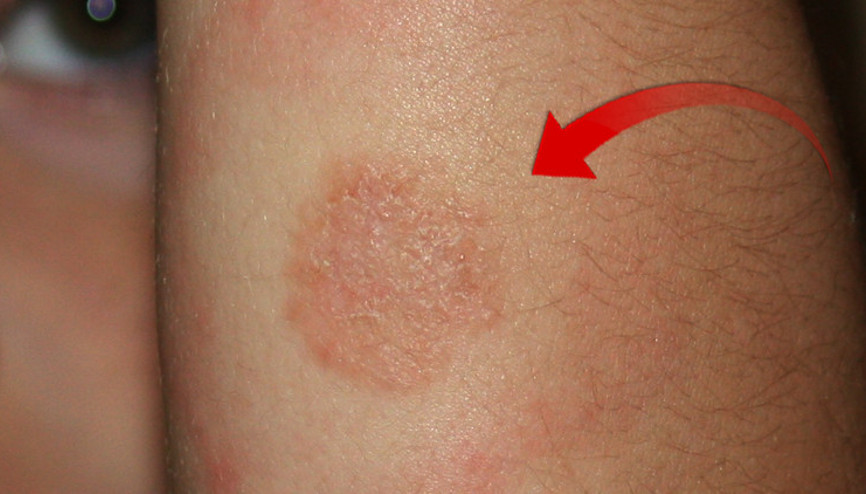 Kenelerden bulaşıyor, tedavi edilmezse tüm vücuda yayılıyor