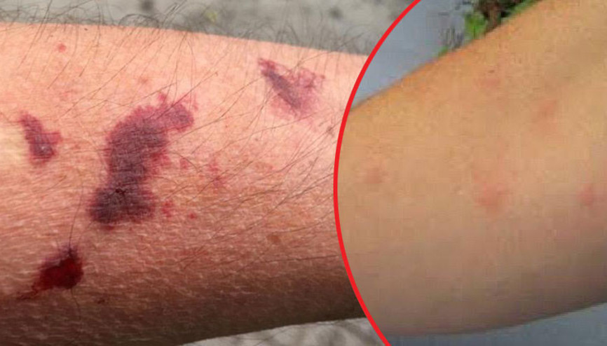 Sapancada büyük panik Asya kaplan sivrisineği yine ortaya çıktı