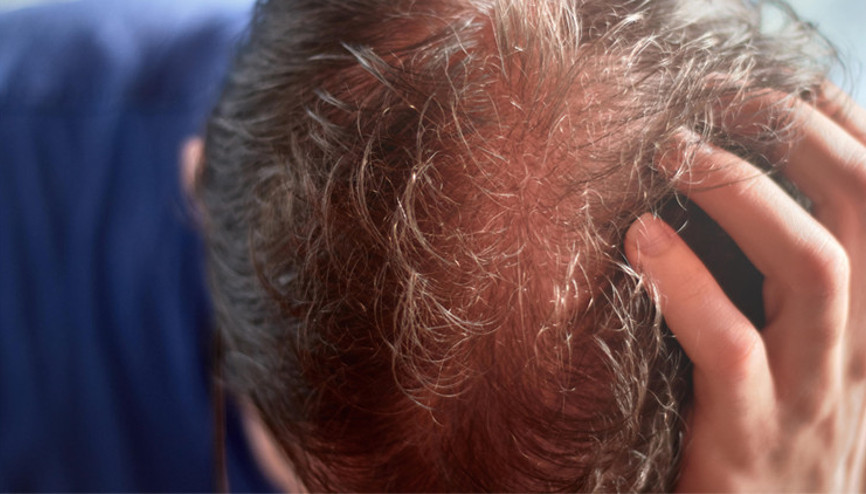 Obezite cerrahisi ve saç dökülmesi