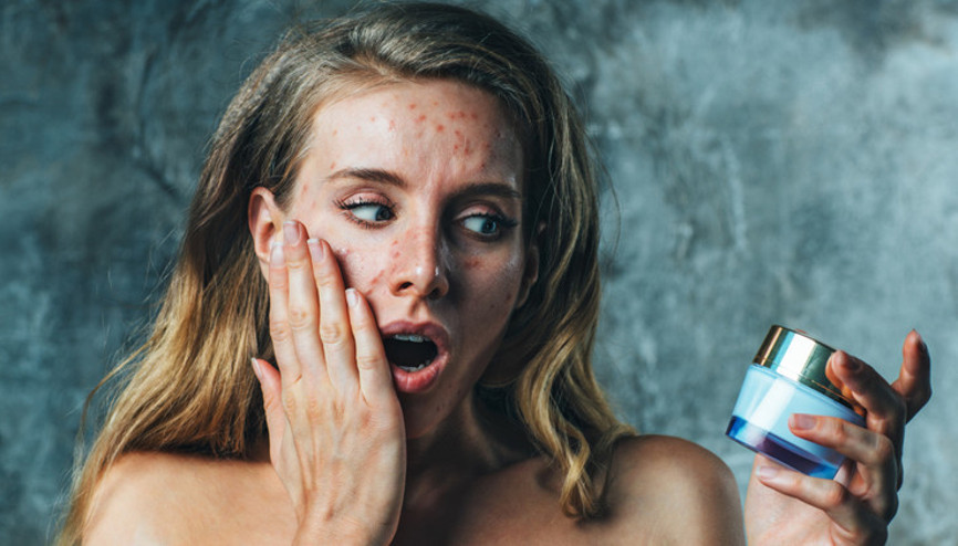 İlaç Kullanmadan Sivilce İzleri Nasıl Geçer