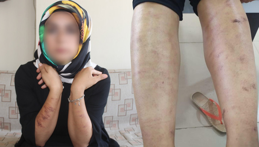 Bir güzellik merkezi skandalı daha Genç kadının vücudu yandı…