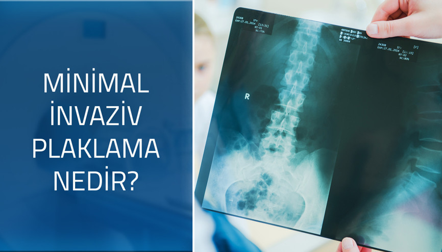 Ortopedi ve Travmatoloji Uzmanı Prof. Dr. Ufuk Özkaya cevaplıyor; Minimal invaziv plaklama nedir, nasıl yapılır, avantajları nelerdir