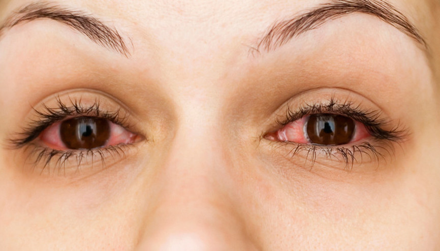 Çok sık görülmüyor diyerek uyardı: ‘Kırmızı göz’ belirtisi