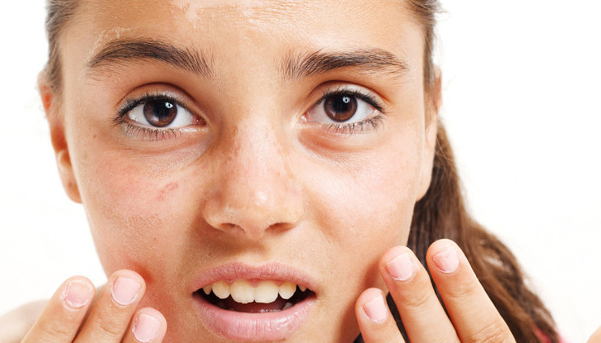 Güneş lekelerini tedavi ettirin, cildinizi kışa hazırlayın