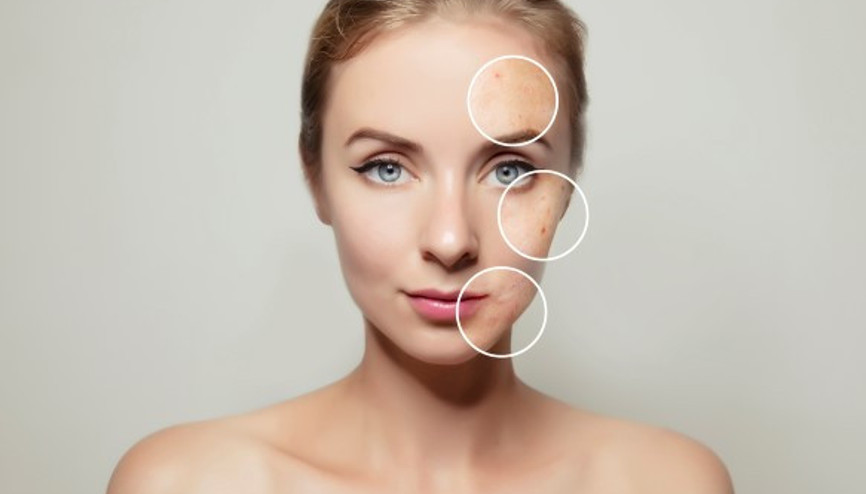 Sonbaharda Güneş Lekesi Tedavisi Nasıl Yapılmalı