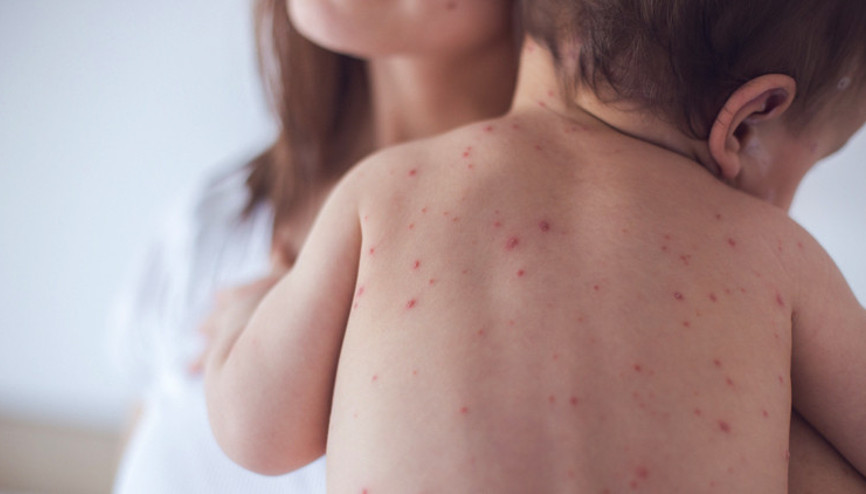 Aşı karşıtlığında artış var… Kızamık tehlikesi geri mi dönüyor