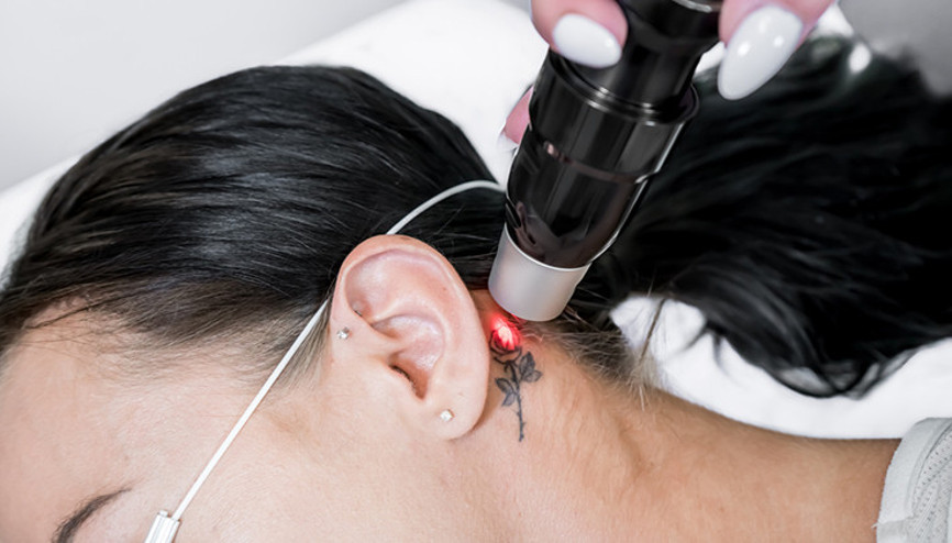 Lazerle Dövme Sildirme Nasıl Yapılır