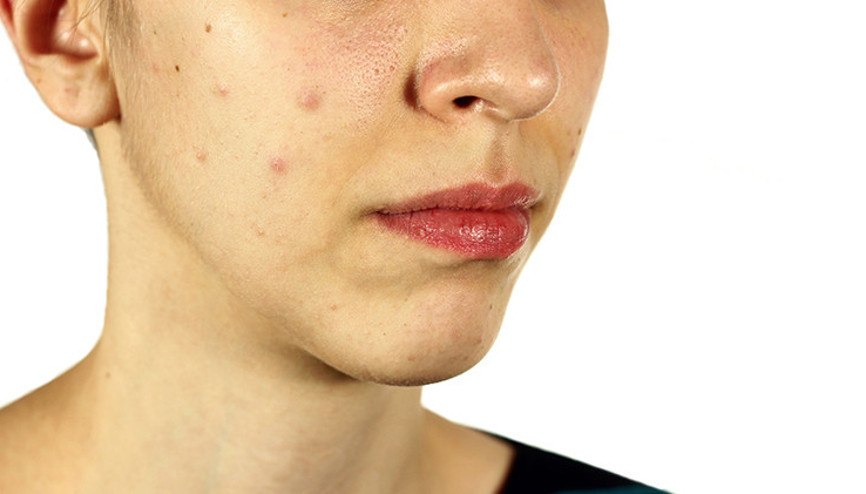 Cildinizdeki sivilceler size ne anlatmak istiyor