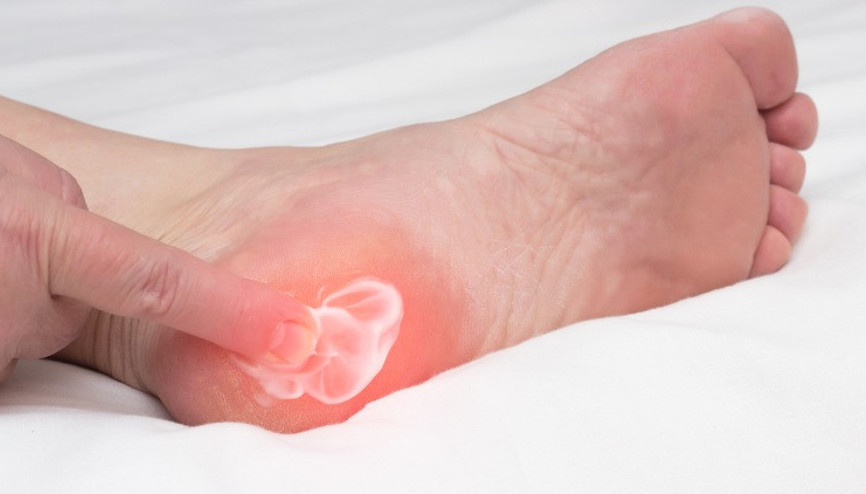 Topuk Dikeni Neden Olur ve Nasıl Geçer