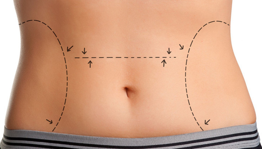 Karın germe (abdominoplasti) ameliyatı nedir