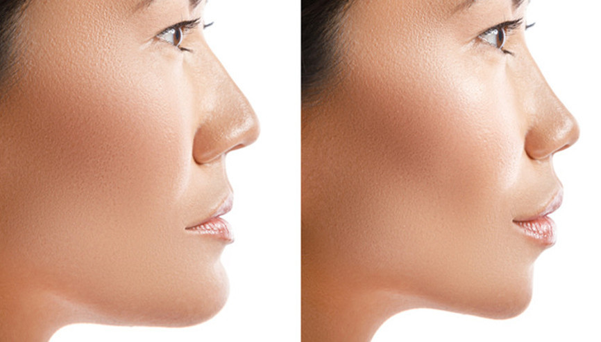 Çene dolgusu nasıl yapılır Çene dolgusu nasıl yapılır