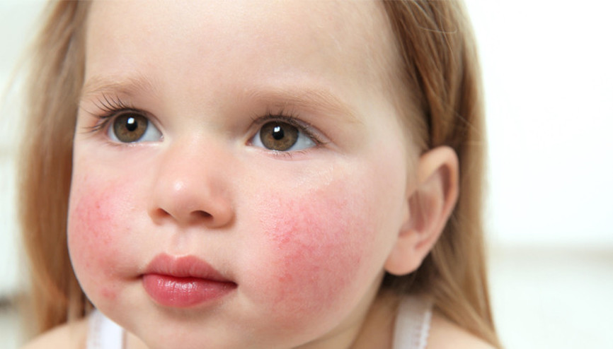 Besin alerjisi olan çocuklar için okullarda alınabilecek önlemler nelerdir