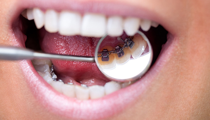 Ortodontide saklı tel tedavisi nedir
