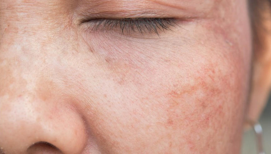 Yüzünüzdeki Lekeler Kabus Olmasın