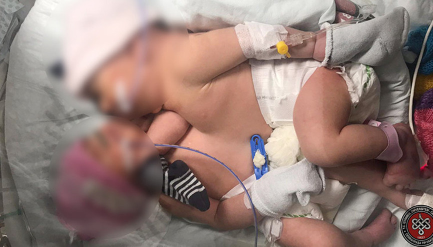 İstanbulda siyam ikizi bebekler doğumdan 8 gün sonra ayrıldı