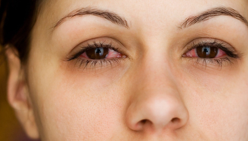 Gözlerimizdeki koronavirüs belirtileri, kışın sık rastlanan adenovirüs belirtileri ile çok benziyor