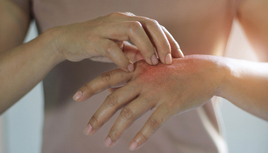 Aşırı dezenfektan kullanımı ellerde egzamaya davetiye çıkarıyor