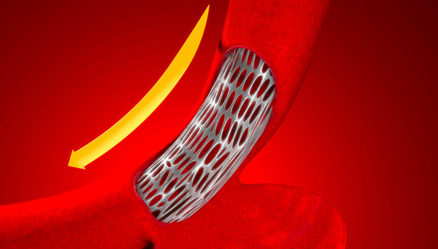 Abdominal aort anevrizması nedir Sebepleri ve belirtileri nelerdir