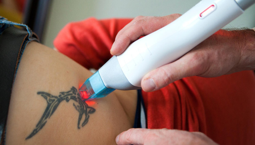 Dövme silme işlemi nasıl yapılır