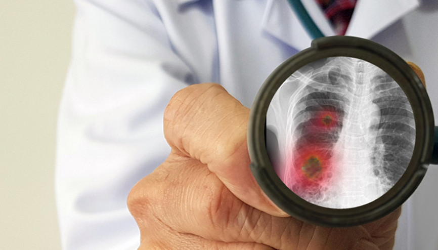 Kalabalık ortamlarda bulaşma riski artıyor… Zatürreden korunmak mümkün