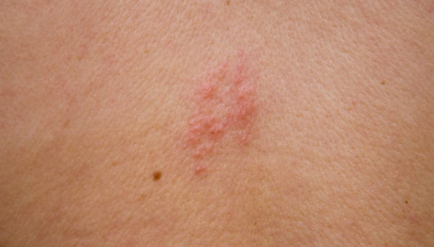 Herkeste görülebiliyor... Bu belirtilere dikkat Herkeste görülebiliyor... Bu belirtilere dikkat