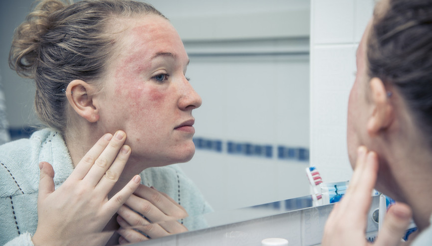 Lupus Hastalığı Nedir Lupus Hastalığı Kimlerde Görülebilir