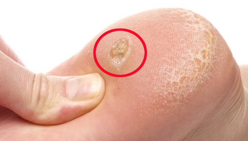 Nasır tedavisi nasıl yapılır, kesin çözümü var mı