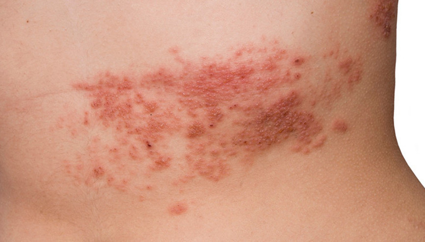 Zona nedir, belirtileri nelerdir Zona bulaşıcı mıdır Zona nedir, belirtileri nelerdir Zona bulaşıcı mıdır