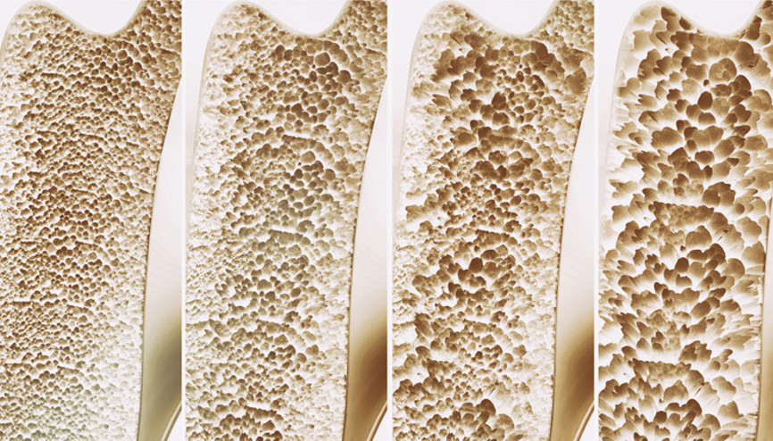 Hepsi kemiklerin düşmanı… Bu alışkanlıklarınızdan hemen vazgeçin