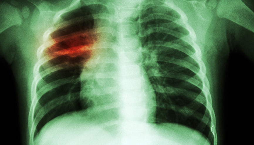 Her 22 Saniyede 1 Kişi Veremden Hayatını Kaybediyor İşte Bilinmesi Gerekenler...