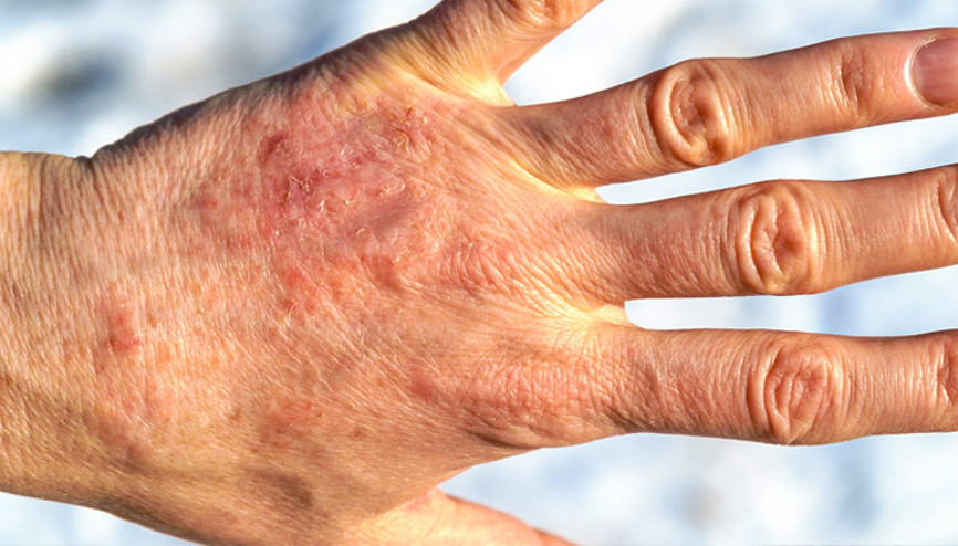 Cildinizdeki kırmızımsı ve kaşıntılı lekelere dikkat Sebebi “soğuk alerjisi” olabilir