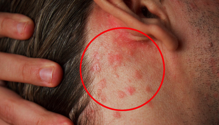 Dikkat, soğuk havalarda risk artırıyor Kaşıntıdan gece uykularını unutturabilir