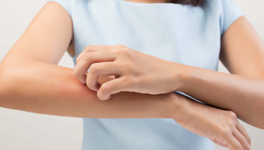 Sedef hastalığı olanlarda farklı rahatsızlıklara da rastlanabiliyor Sedef hastalığı olanlarda farklı rahatsızlıklara da rastlanabiliyor