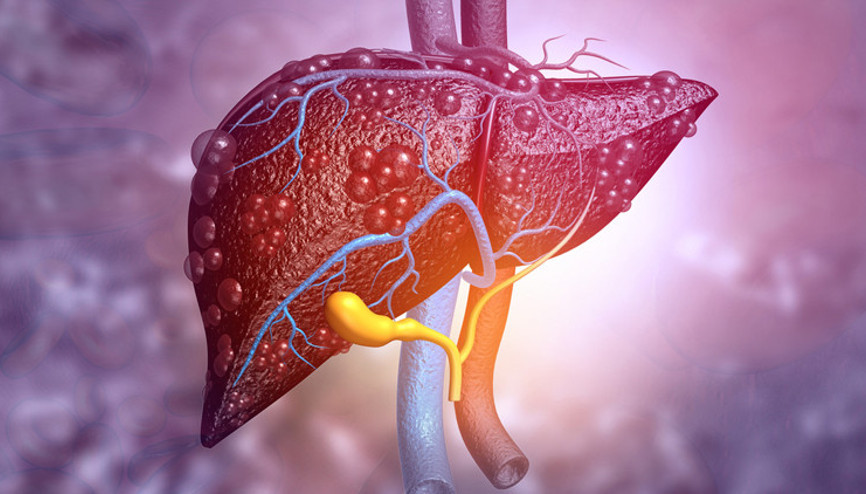 Karaciğer yağlanması neden olur, nasıl tedavi edilir