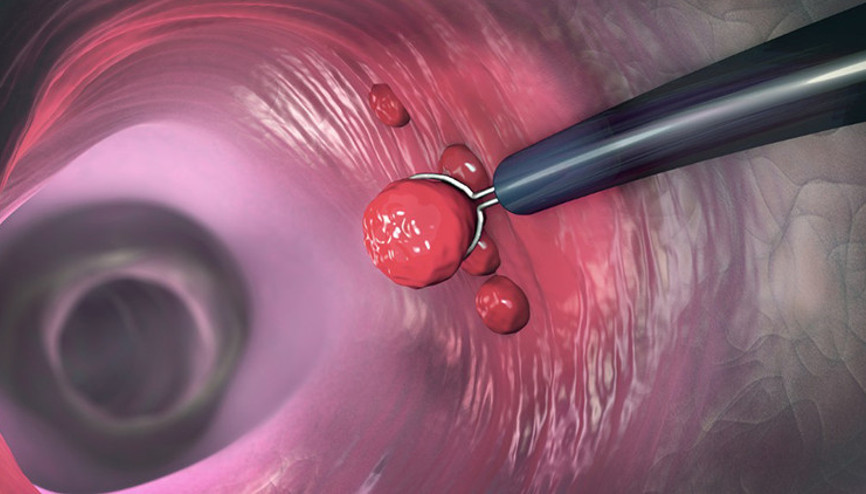 40 yaş üstü bireylere 5 yılda bir kolonoskopi yapılması erken tanı için çok önemli