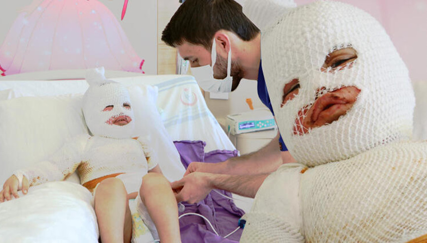 Çaydanlığın devrilmesiyle bu hale geldi