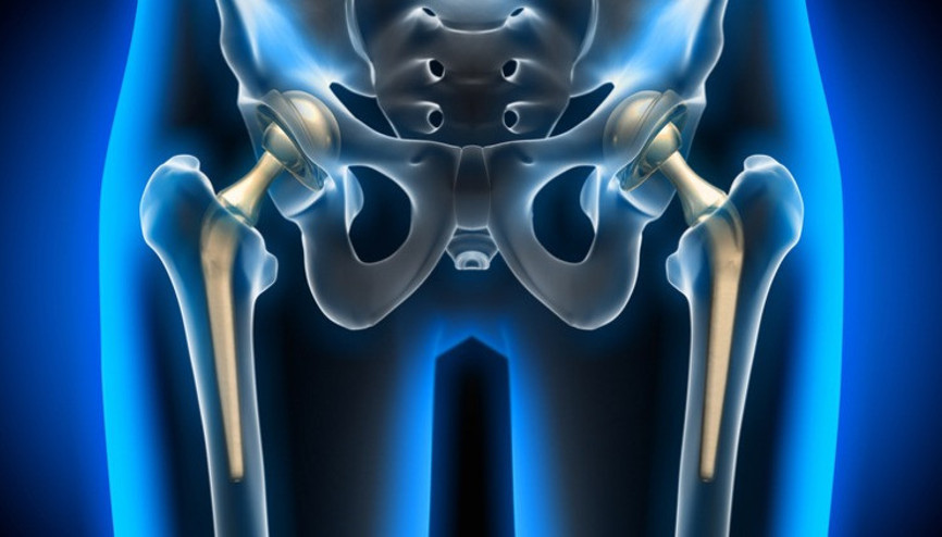 Kalça Protezi Ameliyatı Sonrası Rehabilitasyon