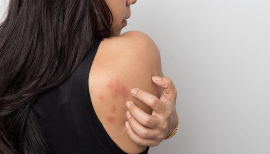 Ürtiker hastalığı nedir Esra Dermancıoğlu ürtiker hastası olduğunu açıkladı