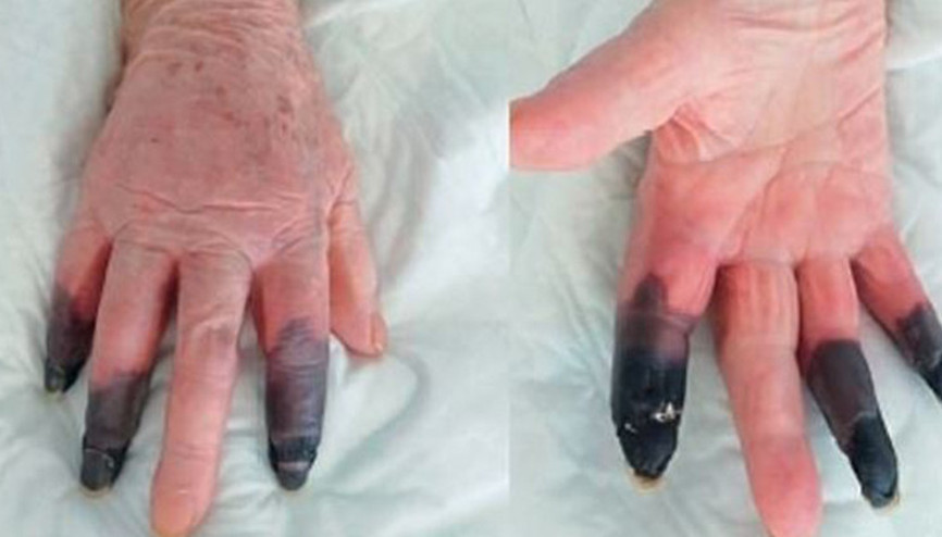 Kovid-19a yakalandı, kangren olan parmaklarını kaybetti